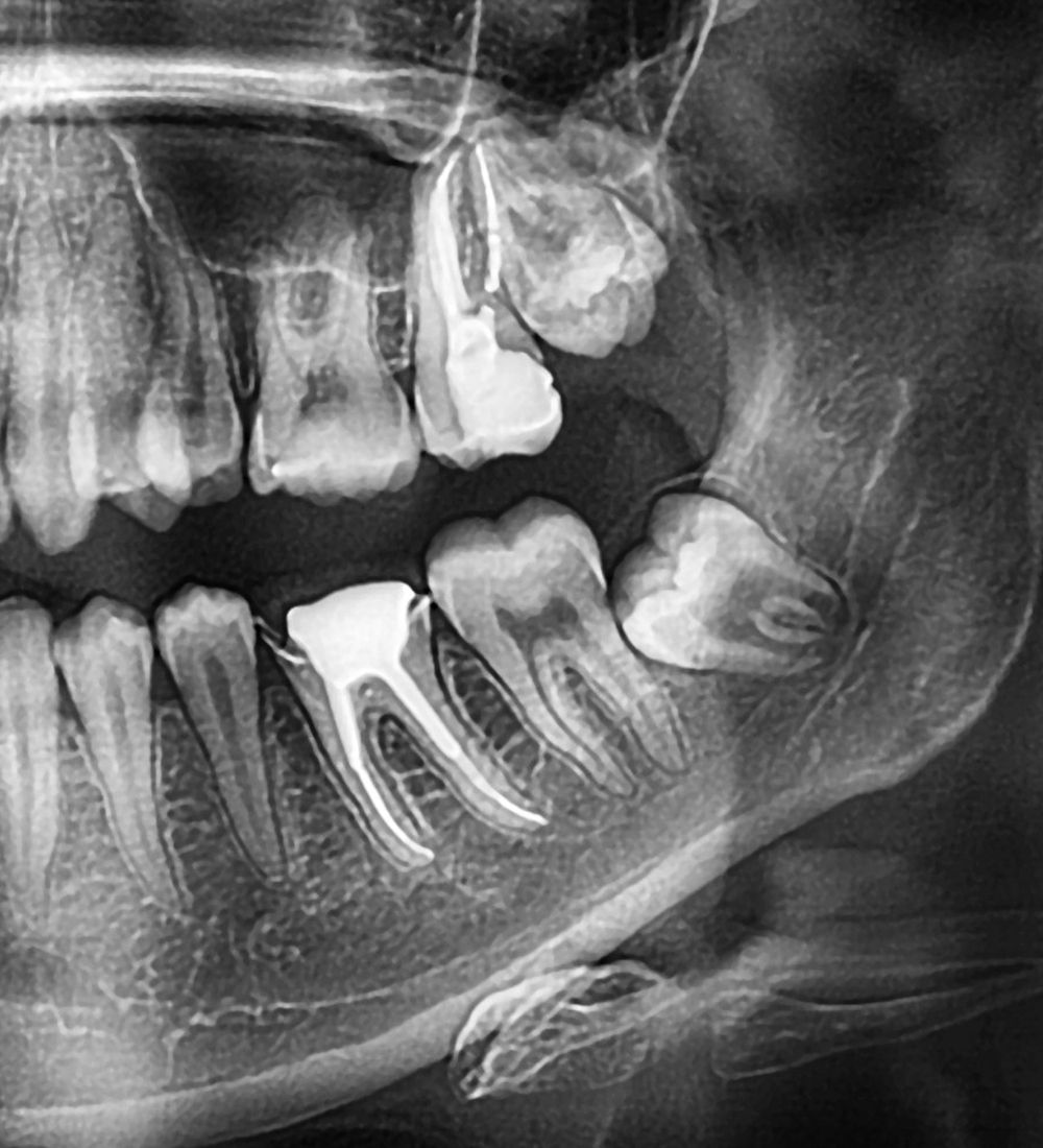 Röntgenbild der Weisheitszähne eines Patienten – Grundlage für die oralchirurgische Behandlung bei Dr. Hennies in Göttingen.
