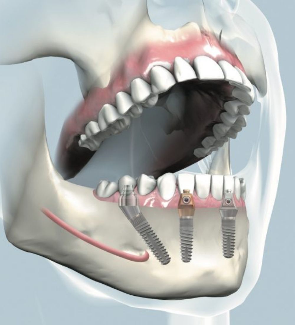 Grafische Darstellung des All-on-4 Implantatkonzepts zur Sofortversorgung bei Dr. Hennies in Göttingen.